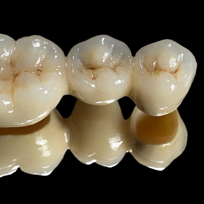 Porcelain Crown and Bridge - Image 5
