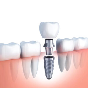 Dental Implants (All Kinds)