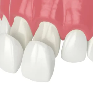 Veneer Crown