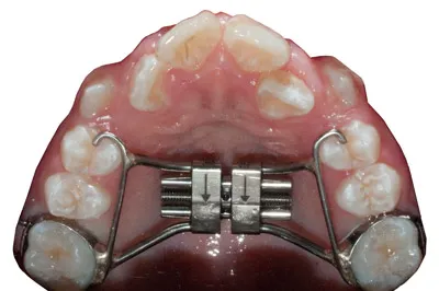 Expansion Screw - Image 4